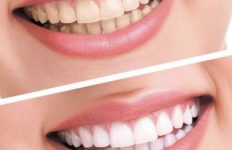 نورلين 6 وصفات منزلية للتخلص من اصفرار الاسنان