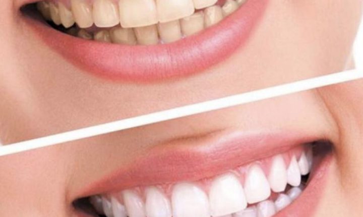 نورلين 6 وصفات منزلية للتخلص من اصفرار الاسنان