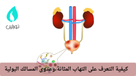 كيفية التعرف على التهاب المثانة،وعدوى المسالك البولية