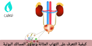 كيفية التعرف على التهاب المثانة،وعدوى المسالك البولية