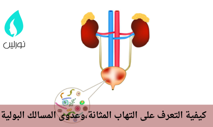 كيفية التعرف على التهاب المثانة،وعدوى المسالك البولية